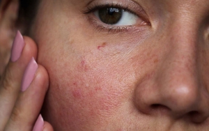 نکات اصلی برای مراقبت از پوست حساس را یاد بگیرید